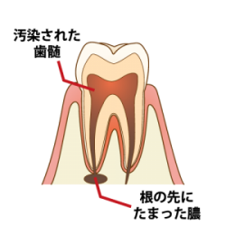 歯髄と膿