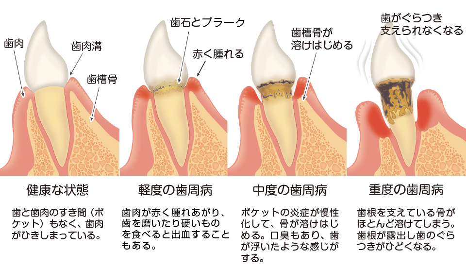 歯周病の進行
